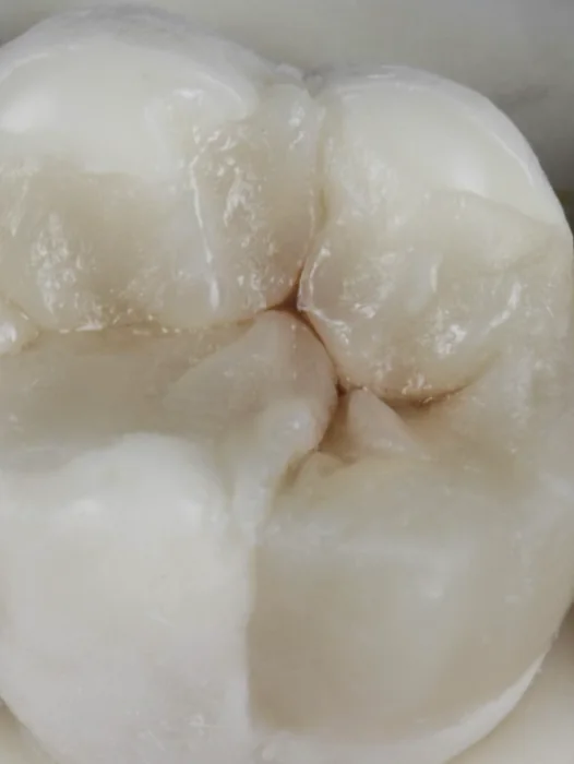 Restauração posterior com anatomia oclusal